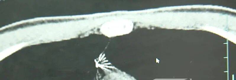 17岁小伙参军体检发现胸腔内有根5cm缝衣针,父母回忆或是1岁时扎入,取出时已锈迹斑斑