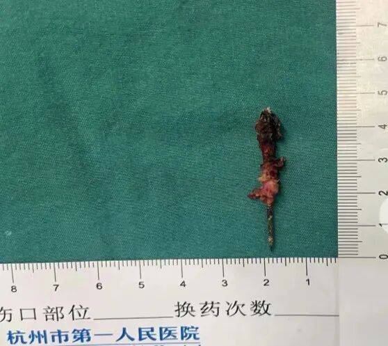 17岁小伙参军体检发现胸腔内有根5cm缝衣针,父母回忆或是1岁时扎入,取出时已锈迹斑斑